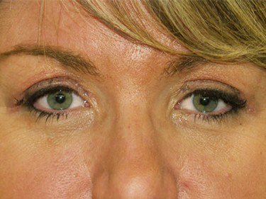 Eyelid Lift P02 After