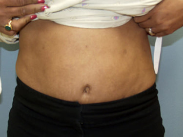 Liposuction P06 After