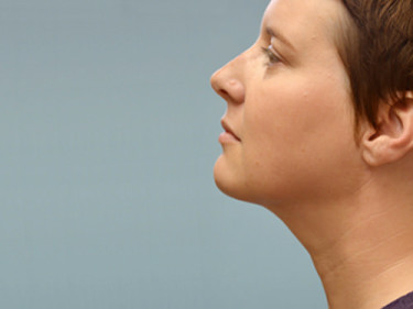 Neck Lift P02 After