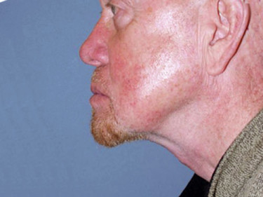 Neck Lift P03 After