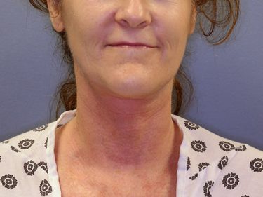 Neck Lift P05 After 1