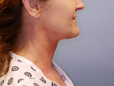 Neck Lift P05 After 2
