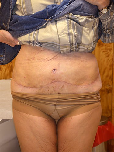 Tummy Tuck P02 After
