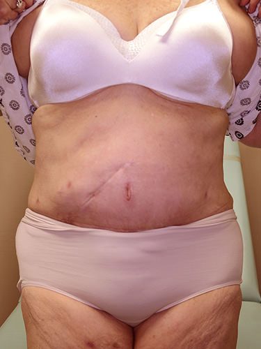 Tummy Tuck P04 After